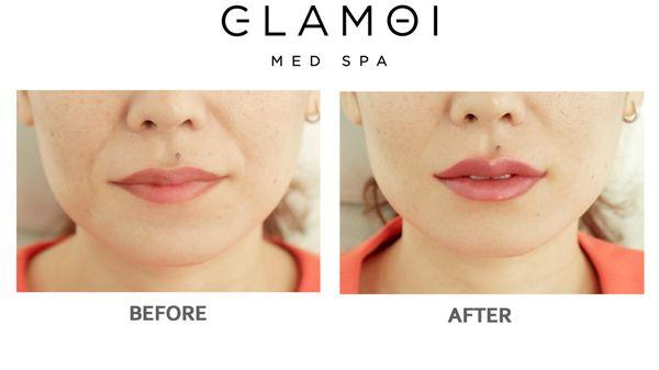 Before and After Lip Filler. Glamoi MedSpa client  photo.