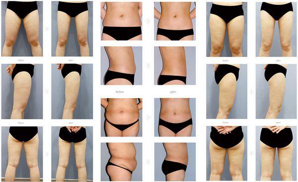 Liposuction Before & After