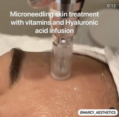 Microneedling- This treatment can be used to correct:

Photoaged skin
Scars
Skin laxity
Stretch marks
Wrinkles