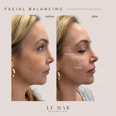 Facial Balancing. Areas treated: Temples, cheeks, lips, and chin