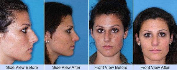 Rhinoplasty Surgery Before & After