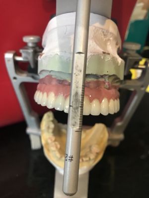 Screw Retained Implants