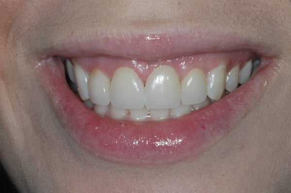 Veneers-After