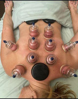 Cupping and hot stones!