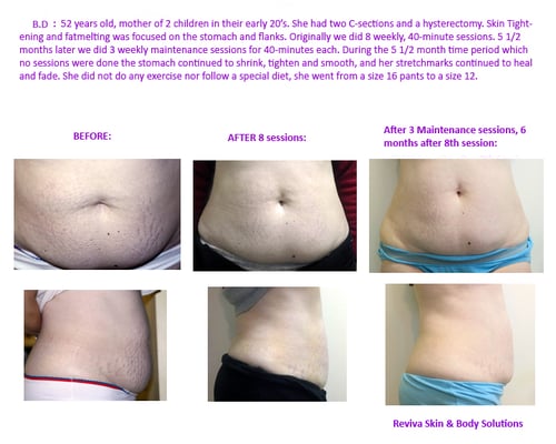 Stomach reduction and stretchmark healing with Radio Frequency. 8 sessions.