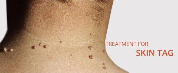 Skin tag treatment