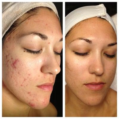 After Salicylic Acid peels