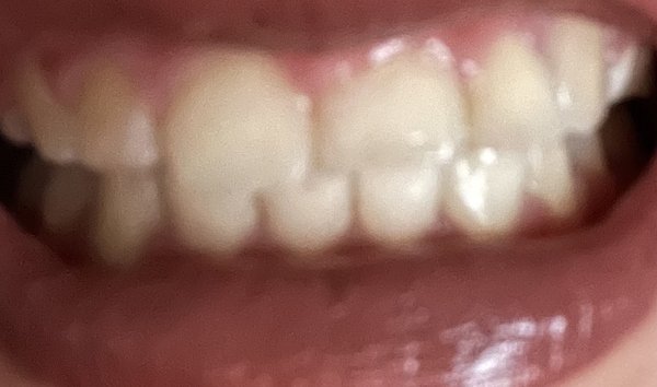 Misaligned middle teeth