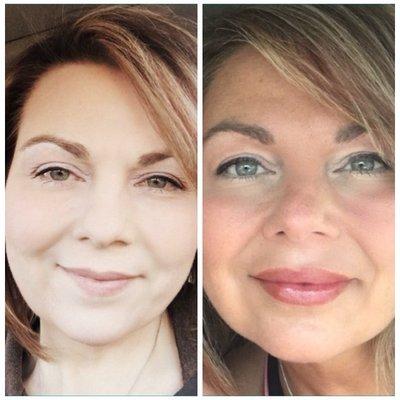 Prior to any work 1 year before 2nd picture. I had Botox on 11's, juvaderm x2 in lips & Radiesse for  Fullness in my cheeks.