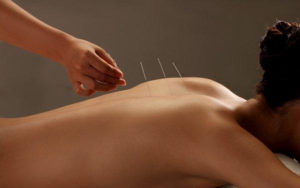 Gentle Japanese Style Acupuncture