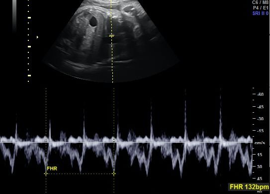 Early Gender Ultrasound