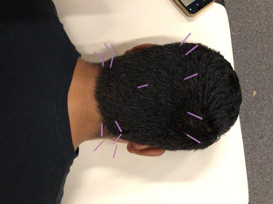 Dry Needling for head and neck pain