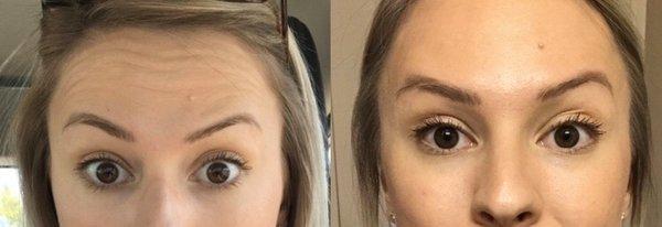 Before and after Botox to soften forehead lines