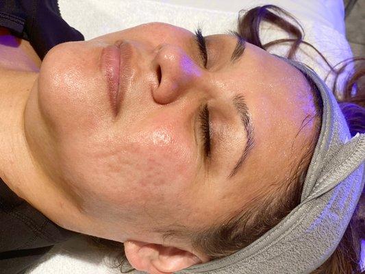 Hydrafacial