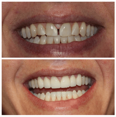 Invisalign and veneers, made a huge difference for our patient. She's not self conscious of her smile anymore.