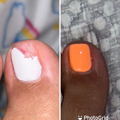 My toenail split almost in half.  Kathy did an overlay and it looks so natural!