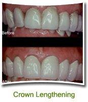 Crown Lengthening Procedure