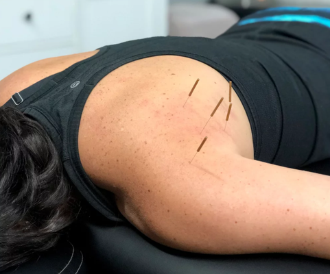 Dry needling offered