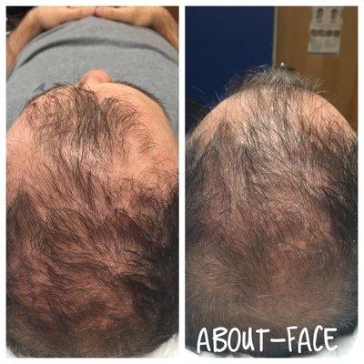 Hair growth after one PRP treatment.