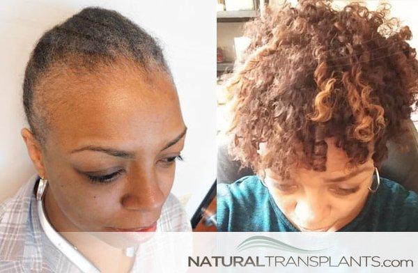 African American Female Hair Transplants