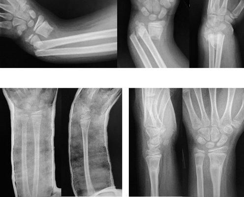 no surgery! initial images (top images) + images after 30 minutes (bottom left) and two months after (bottom right)