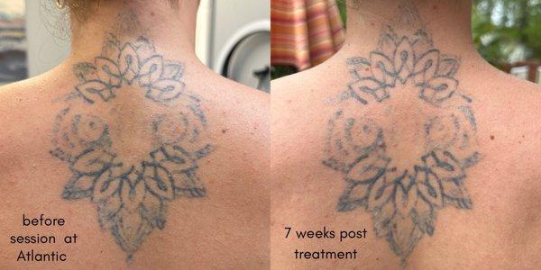 Atlantic Laser Tattoo Removal