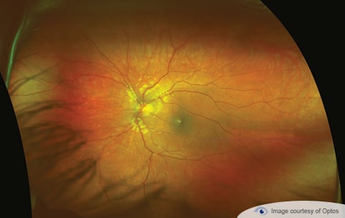 optomap image of a healthy eye