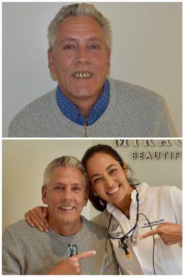 All on Four - fixed Denture - non removable teeth