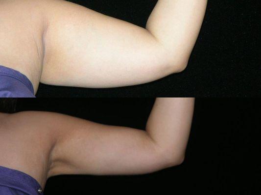 30 year old before and after arm liposuction