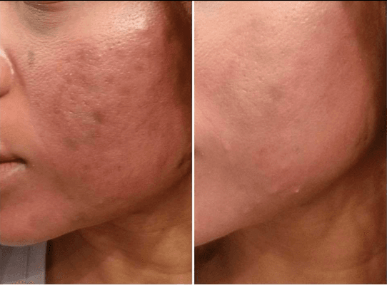 Microneedling/PRP