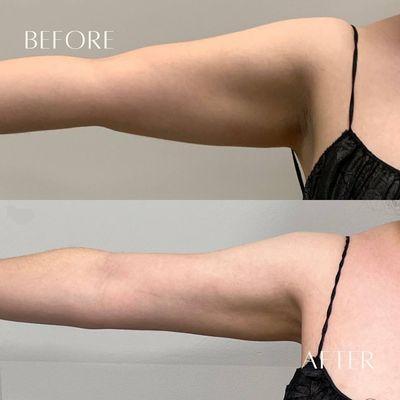 Arm Lipo