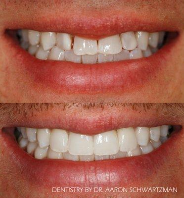 Veneer and ortho smile.