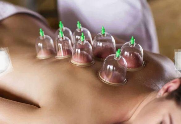 Cupping