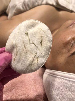 DermPlane treatment. Remove dead skin and peach fuzz.