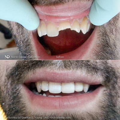 A conservative restoration using dental resin composite bonding gave this patient his smile back.