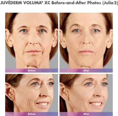 Juvederm / Skin Tightening in Washington, DC 20006