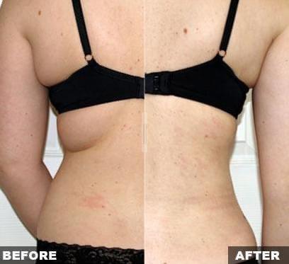 Before & After; lose inches in each VaserShape session!