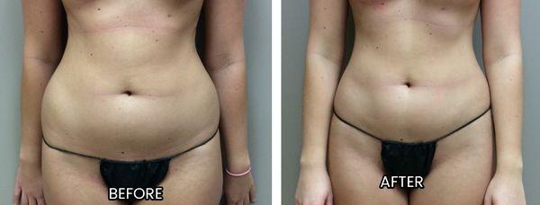 Liposculpting of the waistline