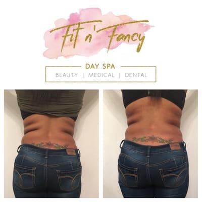 Loose 2"+ inches in as little as 20 minutes from a Strawberry Laser Lipo treatment