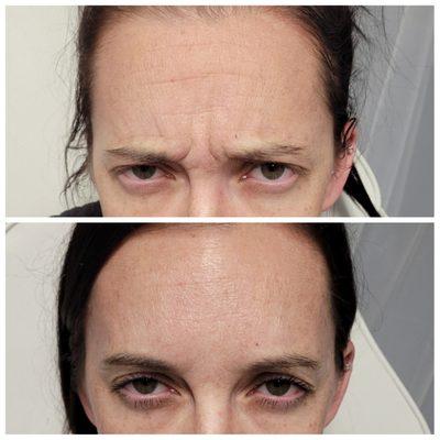 Before and after anti-wrinkle injections with botox!