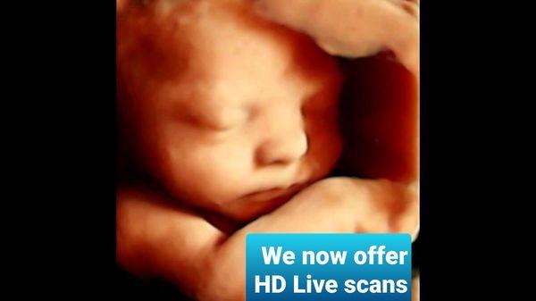 You can now add HD Live service to any ultrasound package.