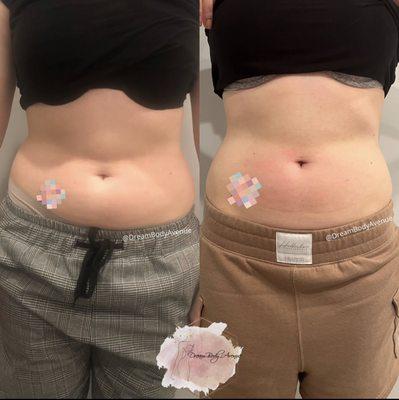 *FAT CAVITATION* Incredible results from only 2 sessions!