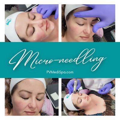 Micro-needling using the DermaFrac-C system