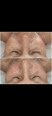 Filler Facial