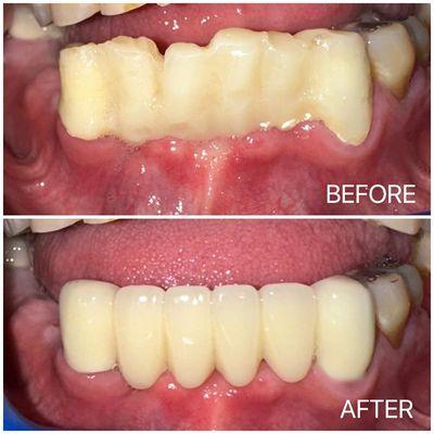 Patient's 6 unit bridge before and after