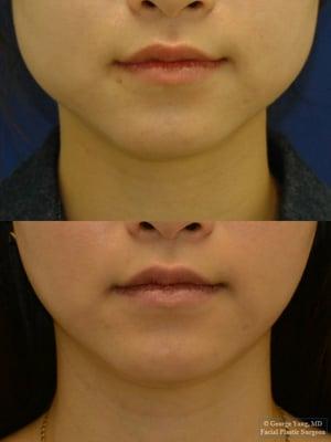 Botox Masseter Reduction- 2 years after initial treatment w/ periodic touch up injections.