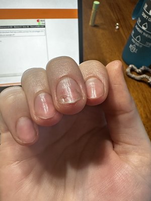 3 weeks after nail damage