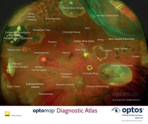 Abnormal retinal conditions that can be found in the back of the eye. Make sure to get your eyes checked yearly!