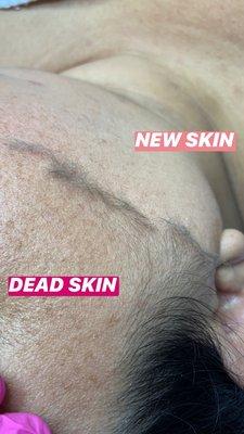 During a Dermaplaning Facial. We remove 2 layers of dead skin & peach fuzz.