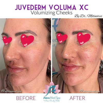 Juvederm Voluma XC for cheek augmentation